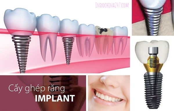 Trồng răng implant nhập từ Mỹ