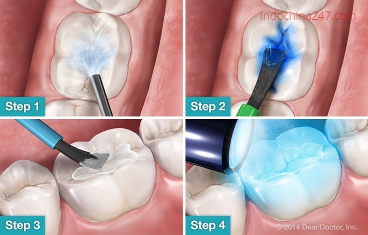 Vận chuyển sản phẩm vật liệu nha khoa từ Mỹ