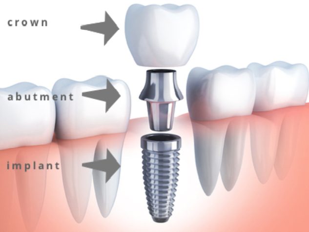 Công ty chuyên nhập khẩu implant nha khoa từ Hàn Quốc